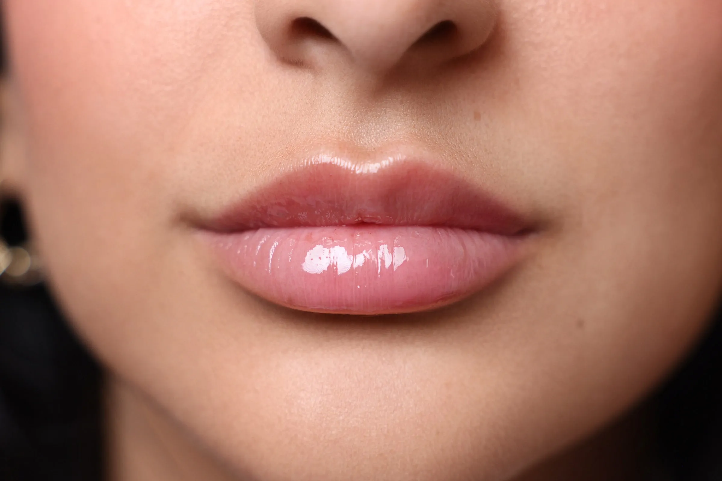 Real Lip Filler result at Dermabless Med Spa Miami, photo 2