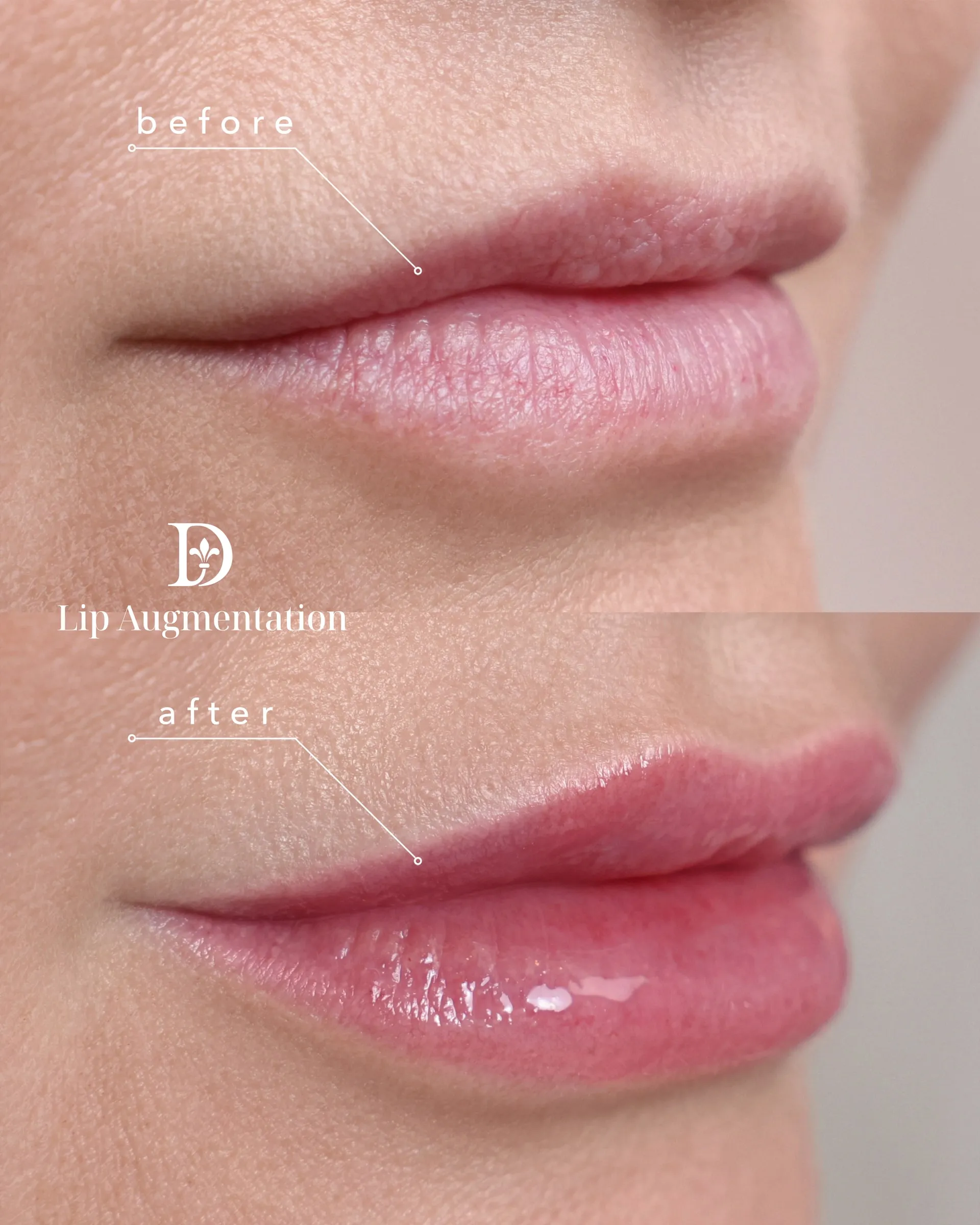 Real Lip Filler result at Dermabless Med Spa Miami, photo 4