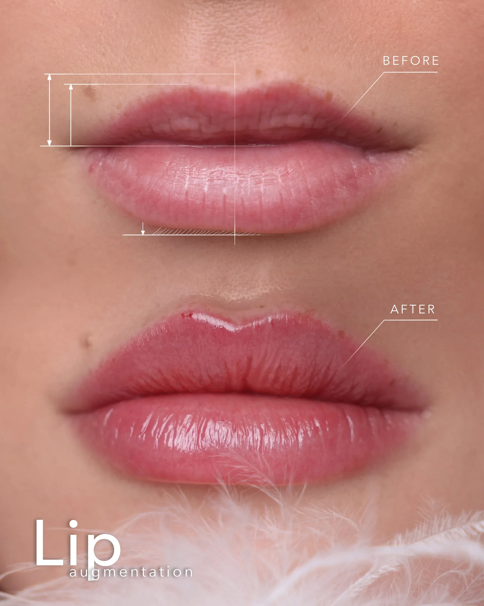 Real Lip Filler result at Dermabless Med Spa Miami, photo 5