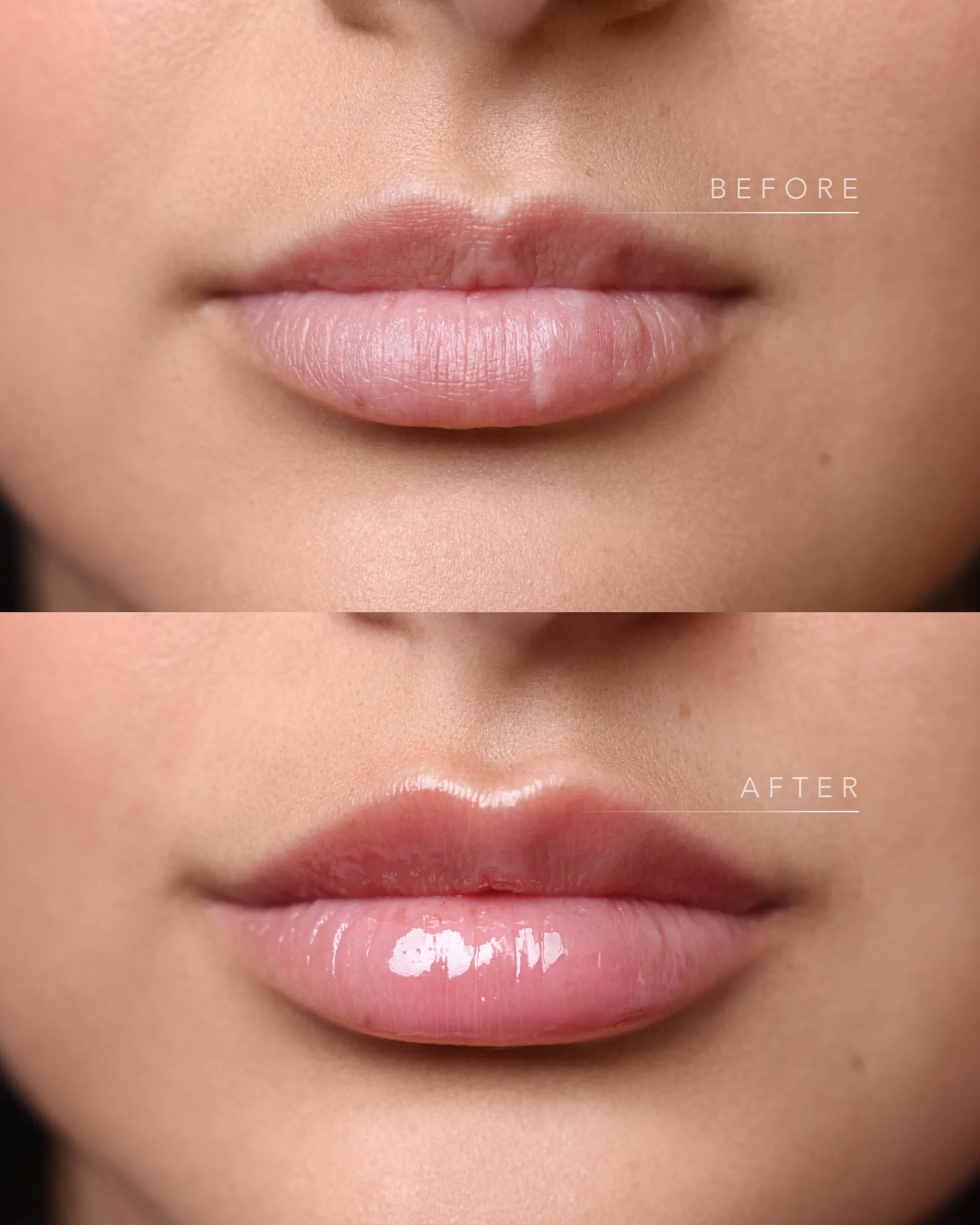 Real Lip Filler result at Dermabless Med Spa Miami, photo 6