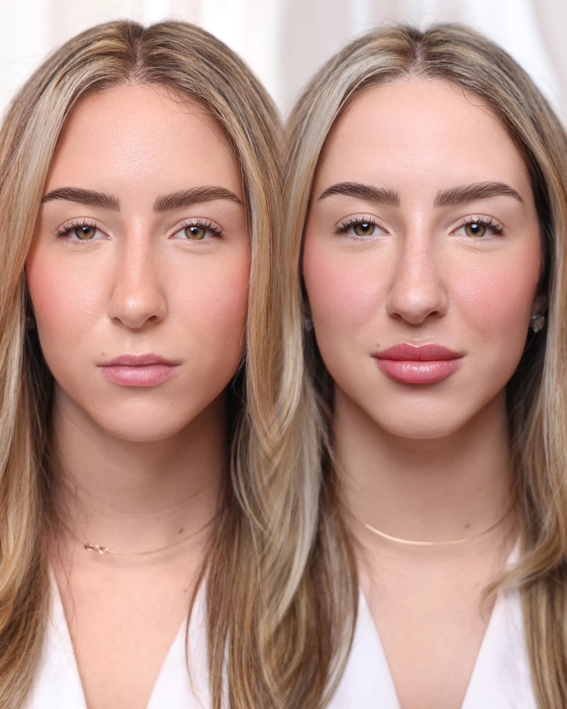 Real Lip Filler result at Dermabless Med Spa Miami, photo 7
