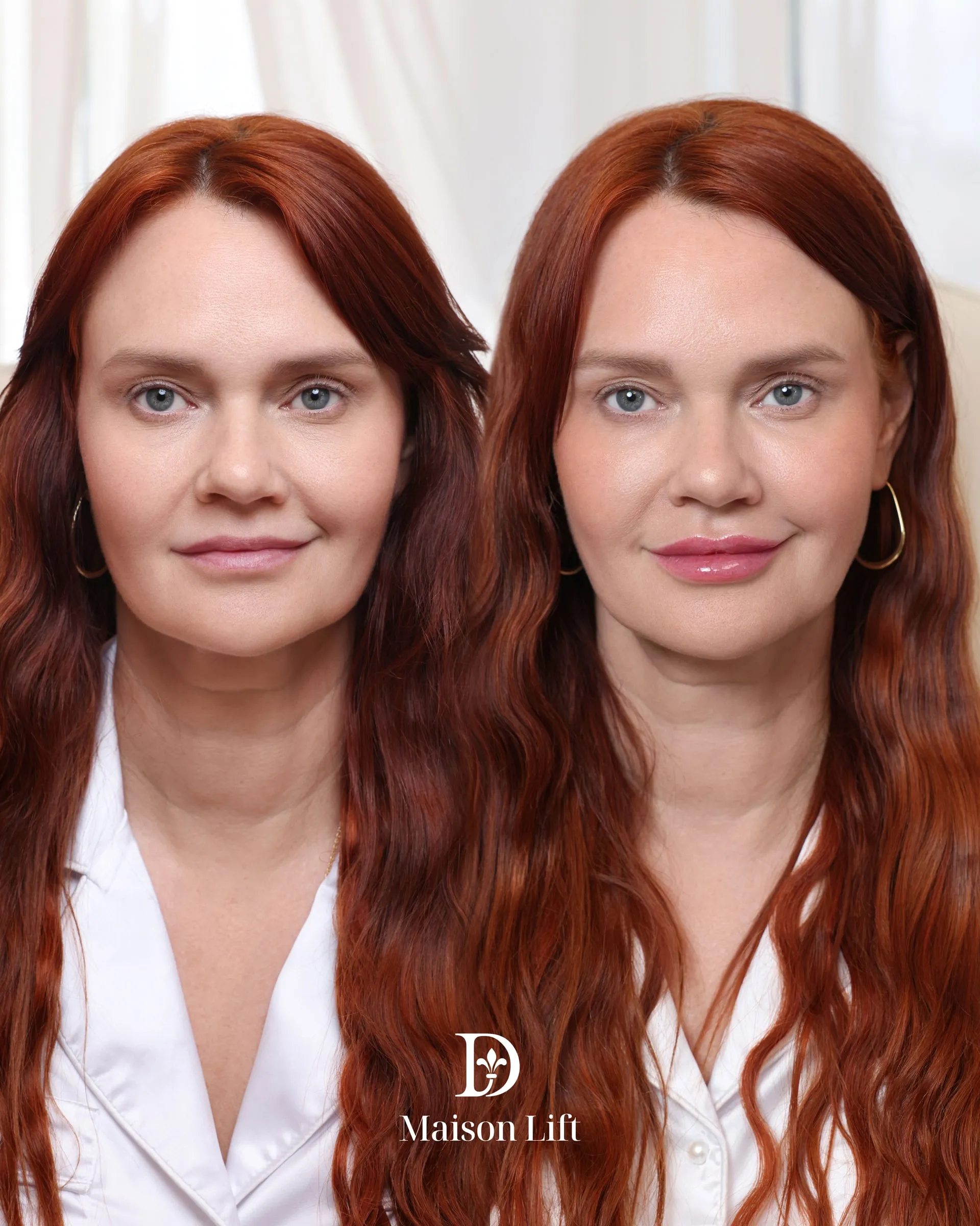 Maison Lift facial harmonization at Dermabless Med Spa Miami.