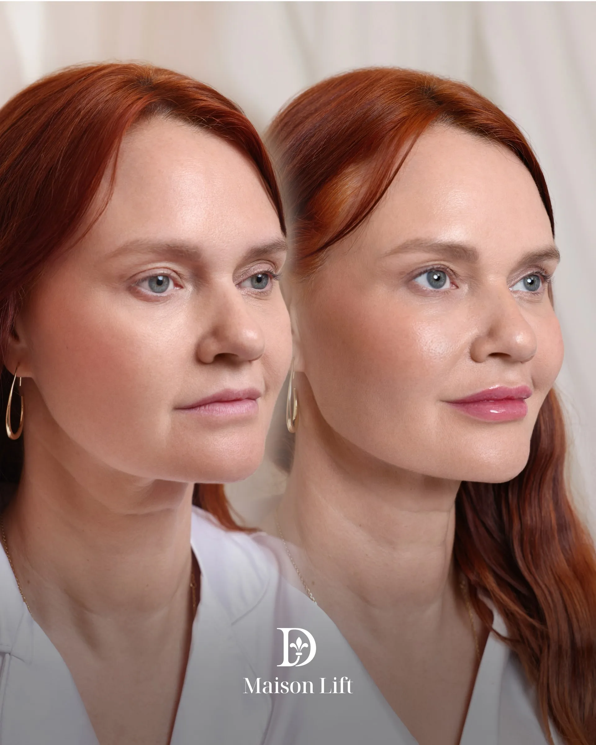Real Maison Lift result at Dermabless Med Spa Miami, photo 1