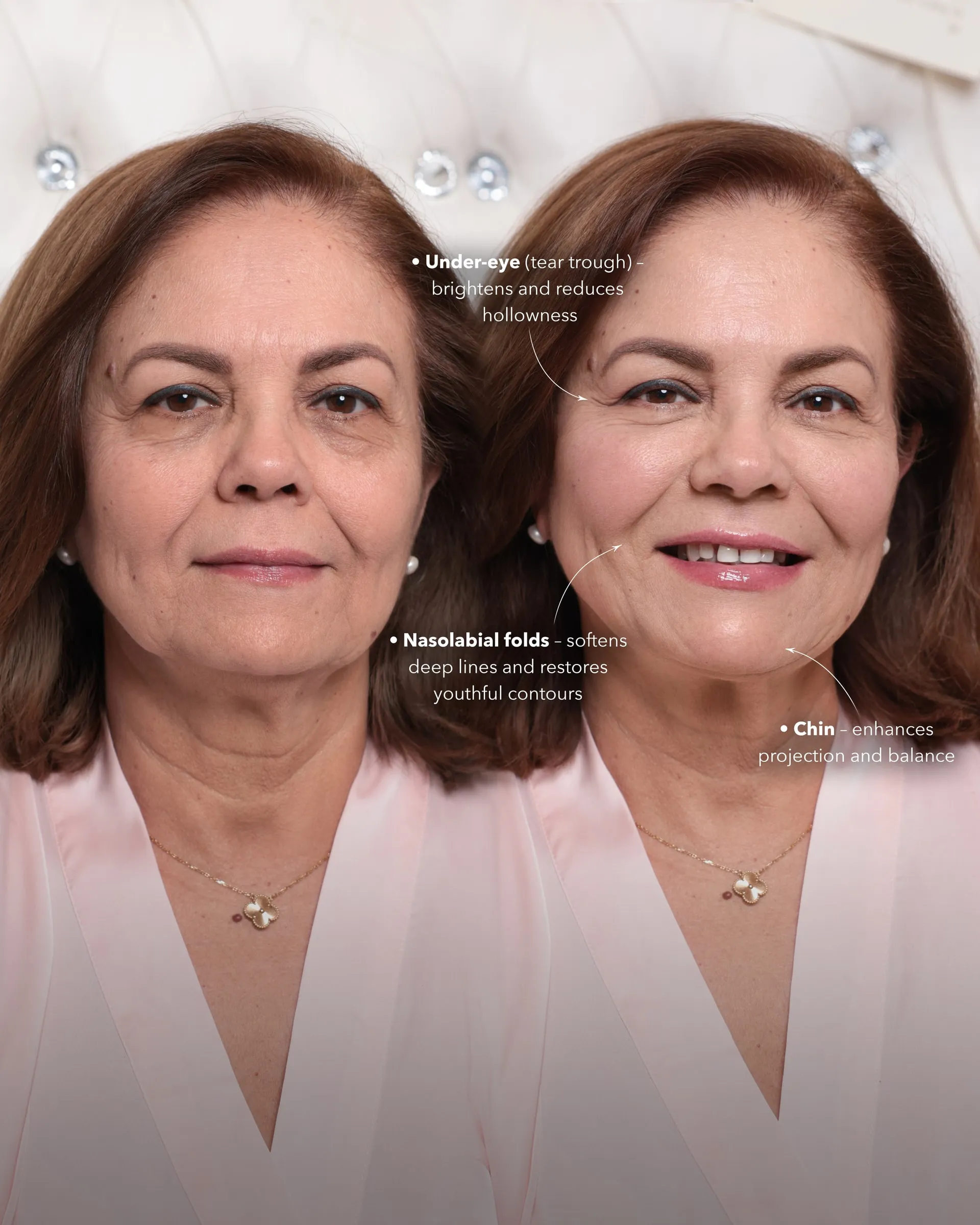 Real Maison Lift result at Dermabless Med Spa Miami, photo 2